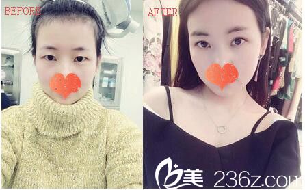 孫生雙眼皮案例