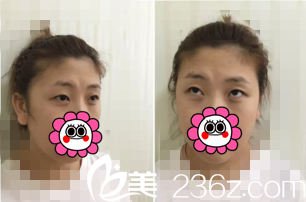 雙眼皮修復(fù)前照片 雙眼皮修復(fù)前照片
