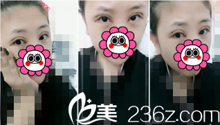 術(shù)后天樣子 術(shù)后天樣子