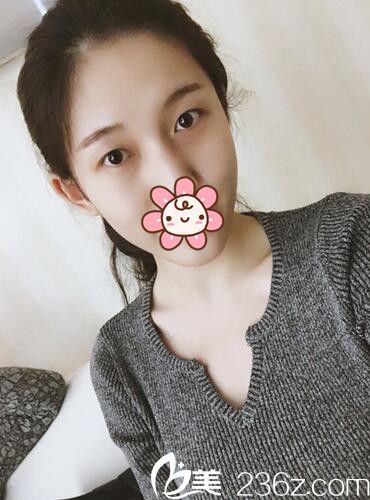 貼雙眼皮貼導(dǎo)致眼皮松弛 貼雙眼皮貼導(dǎo)致眼皮松弛