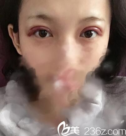 術(shù)后天眼部腫脹 術(shù)后天眼部腫脹