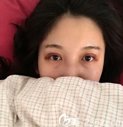 術(shù)后第四天冰敷換熱敷 術(shù)后第四天冰敷換熱敷