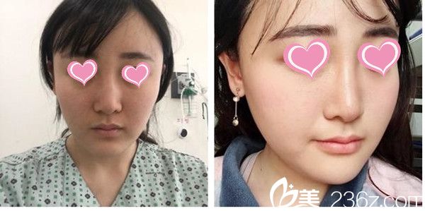 金基范院長玻尿酸隆鼻案例