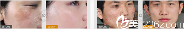 胥宇祛斑祛痘案例 胥宇祛斑祛痘案例