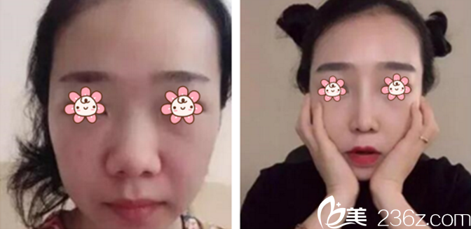 <!--<i data=20240703-sp></i>-->鳳院長鼻綜合案例 <!--<i data=20240703-sp></i>-->鳳院長鼻綜合案例