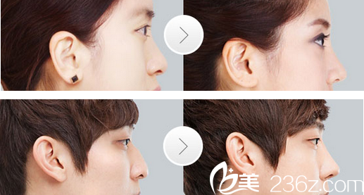 整形美容醫(yī)院假體隆鼻案例 整形美容醫(yī)院假體隆鼻案例