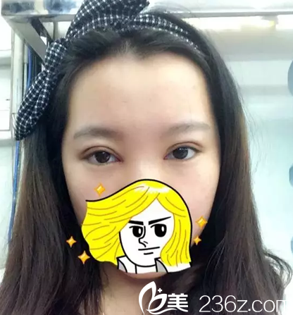 雙眼皮手術(shù)4天還有些腫脹