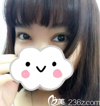 雙眼皮7天拆線效果