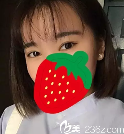 分享在做的雙眼皮恢復(fù)照，你能看出我的手術(shù)痕跡嗎