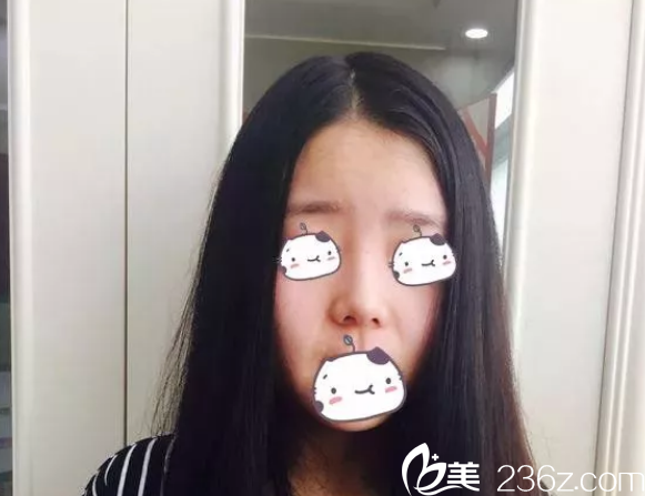 在建國(guó)整形做鼻綜合前的塌鼻子 在建國(guó)整形做鼻綜合前的塌鼻子