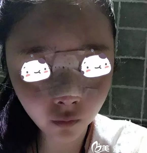 在建國(guó)整形做鼻綜合第1天 在建國(guó)整形做鼻綜合第1天