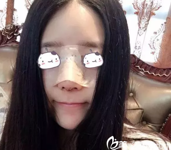 做完隆鼻手術(shù)第2天恢復(fù)照 做完隆鼻手術(shù)第2天恢復(fù)照