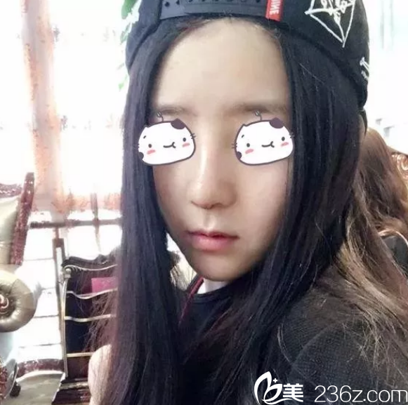 徐建國(guó)耳軟骨隆鼻手術(shù)<span style= 徐建國(guó)耳軟骨隆鼻手術(shù)<span style=