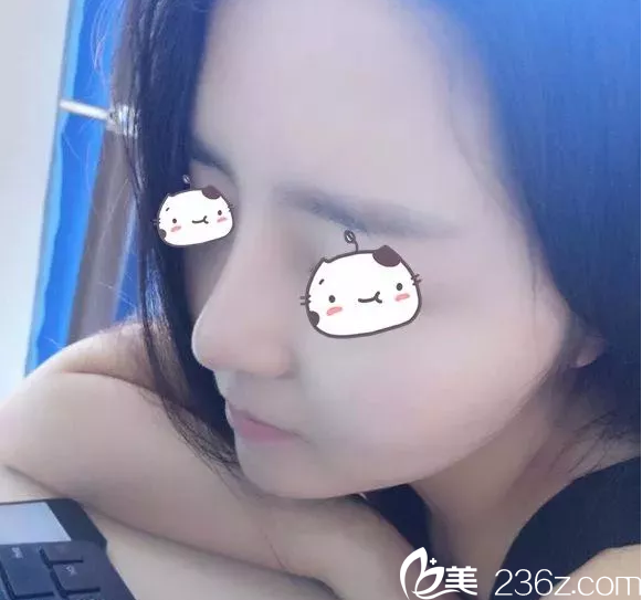 聊一下我在寧波建國整形做硅膠自體耳軟骨隆鼻擺脫20年塌鼻子折磨的快感