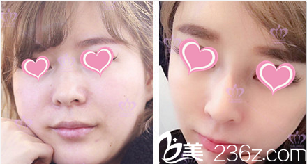 北京雅靚張春彥醫(yī)生面部吸脂案例 北京雅靚張春彥醫(yī)生面部吸脂案例