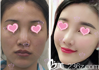 北京雅靚張春彥醫(yī)生自體脂肪面部填充案例 北京雅靚張春彥醫(yī)生自體脂肪面部填充案例