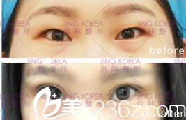 北京京韓醫(yī)療美容診所喬愛生雙眼皮案例