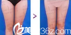 北京京韓王沛森醫(yī)生腿部吸脂塑形案例 北京京韓王沛森醫(yī)生腿部吸脂塑形案例