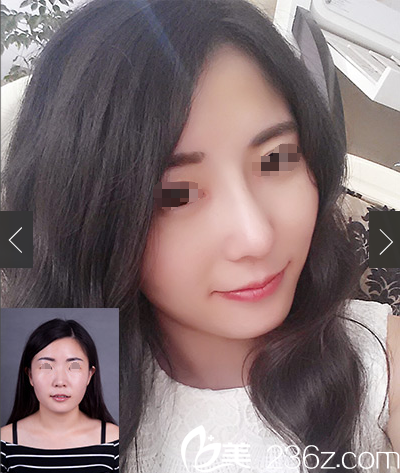 曹海峰主任隆鼻案例