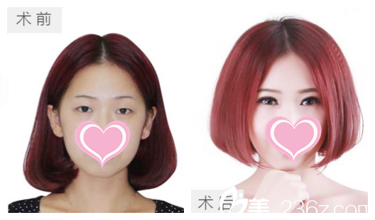 真人雙眼皮前后效果展示 真人雙眼皮前后效果展示