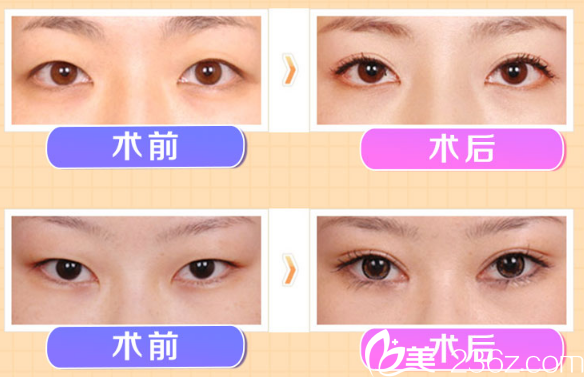 東莞華美整形醫(yī)院詹慧院長雙眼皮案例