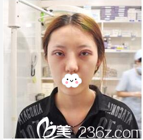 雙眼皮術(shù)后天來廣州曙光換藥 雙眼皮術(shù)后天來廣州曙光換藥