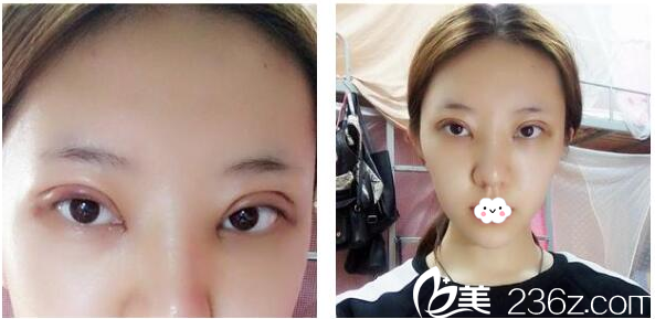 找廣州曙光王娟做完雙眼皮第3天眼部自拍 找廣州曙光王娟做完雙眼皮第3天眼部自拍