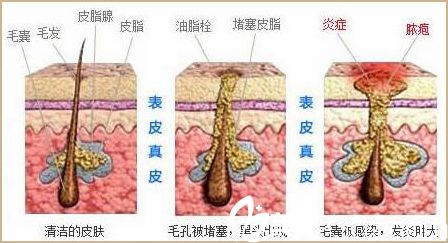 痘痘的形成過程