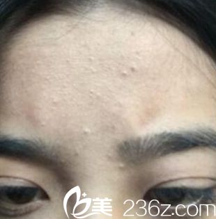 鄭州梨花雨微針祛痘