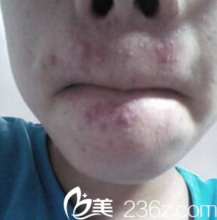 鄭州梨花雨激光祛痘