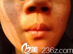 鄭州梨花雨激光祛痘坑痘印