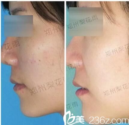 鄭州梨花雨祛痘案例