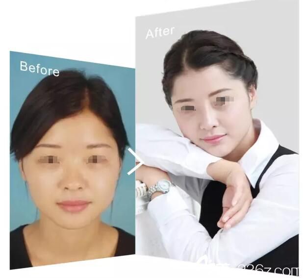 淮安華美鼻綜合整形案例 淮安華美鼻綜合整形案例