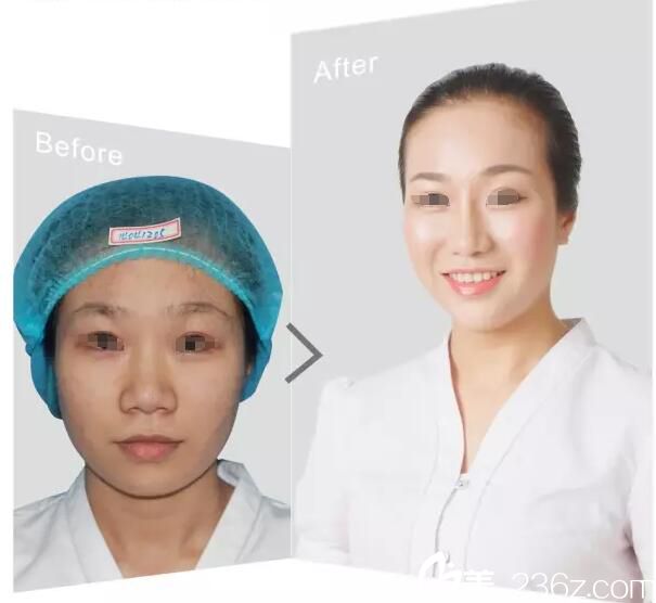 院內員工做鼻綜合整形案例 院內員工做鼻綜合整形案例