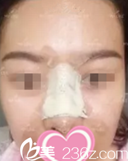 術后當時效果 術后當時效果