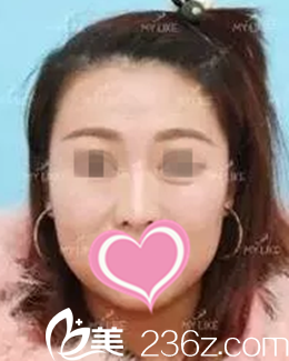 術前鼻子樣子 術前鼻子樣子