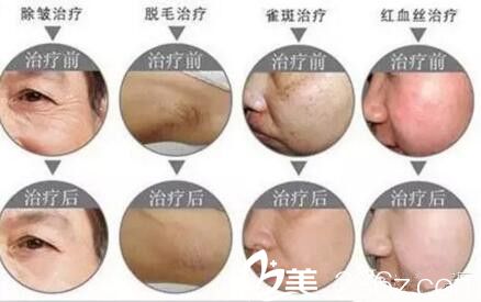 鄭州梨花雨做激光祛痘嫩膚彩光嫩膚治療效果