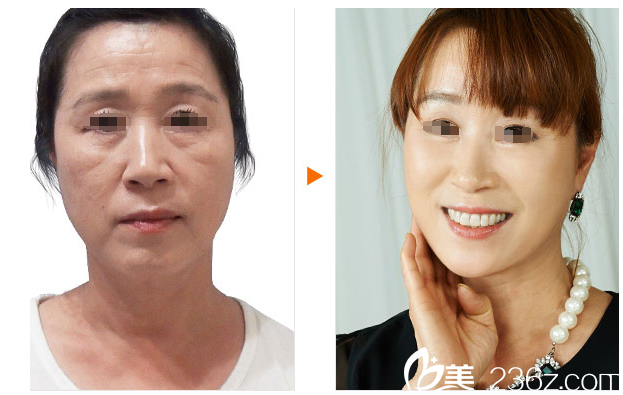 高羅鏞院長除皺案例 高羅鏞院長除皺案例