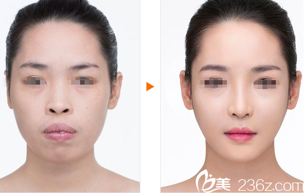 高羅鏞院長隆鼻梁+鼻尖塑形+鼻翼縮小+突嘴矯正 高羅鏞院長隆鼻梁+鼻尖塑形+鼻翼縮小+突嘴矯正