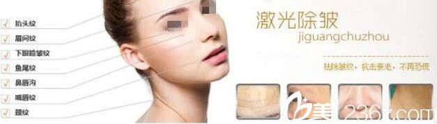 激光除皺適合面部的部位 激光除皺適合面部的部位
