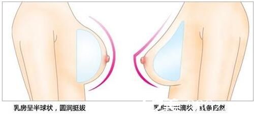 常見的兩種假體形態(tài) 常見的兩種假體形態(tài)