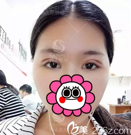 在北海韓美做雙眼皮+開眼角手術(shù)后3天 在北海韓美做雙眼皮+開眼角手術(shù)后3天