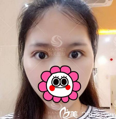 快看看我在北海韓美做雙眼皮+開眼角手術(shù)后7天的效果好不好