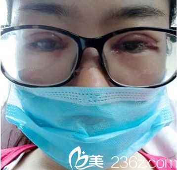 鄭州芳藝雙眼皮手術(shù)當(dāng)天