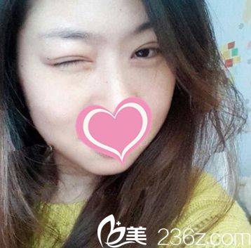 鄭州芳藝做的全切雙眼皮讓我大開(kāi)電眼 術(shù)后睫毛也翹了