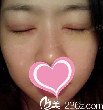 雙眼皮手術(shù)后14天閉眼照