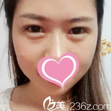 雙眼皮手術(shù)后14天