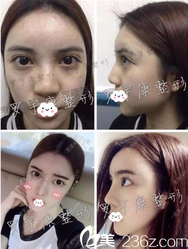 佛山華美整形<!--<i data=20240703-sp></i>-->醫(yī)生做的鼻綜合隆鼻案例 佛山華美整形<!--<i data=20240703-sp></i>-->醫(yī)生做的鼻綜合隆鼻案例