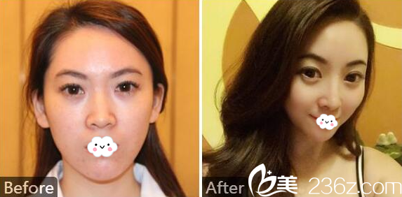 佛山華美整形美容醫(yī)院<!--<i data=20240703-sp></i>-->硅膠隆鼻案例 佛山華美整形美容醫(yī)院<!--<i data=20240703-sp></i>-->硅膠隆鼻案例