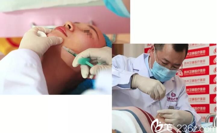 艾莉薇玻尿酸注射下巴